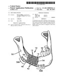 Soft Tissue Spacer diagram and image