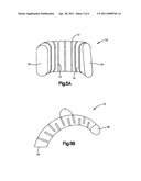 Soft Tissue Spacer diagram and image