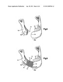 Soft Tissue Spacer diagram and image