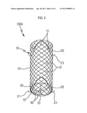 STENT FOR PROSTATIC URETHRA EXPANSION diagram and image