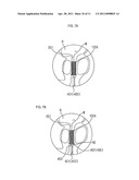 STENT FOR PROSTATIC URETHRA EXPANSION diagram and image