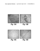 ANTIBODIES AGAINST CD38 FOR TREATMENT OF MULTIPLE MYELOMA diagram and image