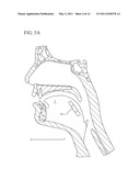 FLEXIBLE IMPLANTS HAVING INTERNAL VOLUME SHIFTING CAPABILITIES FOR TREATING OBSTRUCTIVE SLEEP APNEA diagram and image