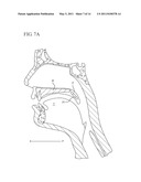 FLEXIBLE IMPLANTS HAVING INTERNAL VOLUME SHIFTING CAPABILITIES FOR TREATING OBSTRUCTIVE SLEEP APNEA diagram and image