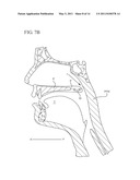 FLEXIBLE IMPLANTS HAVING INTERNAL VOLUME SHIFTING CAPABILITIES FOR TREATING OBSTRUCTIVE SLEEP APNEA diagram and image