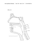 FLEXIBLE IMPLANTS HAVING INTERNAL VOLUME SHIFTING CAPABILITIES FOR TREATING OBSTRUCTIVE SLEEP APNEA diagram and image