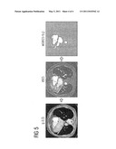 BEAM HARDENING CORRECTION FOR CT PERFUSION MEASUREMENTS diagram and image