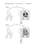 METHOD FOR HIGHLIGHTING LOCAL CHARACTERISTICS IN ANATOMICAL VOLUME RENDERINGS OF VESSEL STRUCTURES AND COMPUTER SYSTEM FOR CARRYING OUT THIS METHOD diagram and image