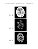 PERFUSION IMAGING diagram and image