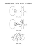 TREATMENT OF RENAL HYPERTENSION OR CAROTID SINUS SYNDROME WITH ADVENTITIAL PHARMACEUTICAL SYMPATHETIC DENERVATION OR NEUROMODULATION diagram and image