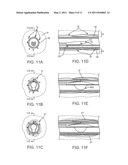 TREATMENT OF RENAL HYPERTENSION OR CAROTID SINUS SYNDROME WITH ADVENTITIAL PHARMACEUTICAL SYMPATHETIC DENERVATION OR NEUROMODULATION diagram and image