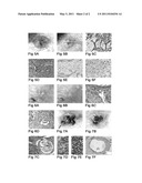 Medicament for treatment of tumors wherein hedgehog/smoothened signaling is employed for inhibition of apoptosis of the tumor cells diagram and image