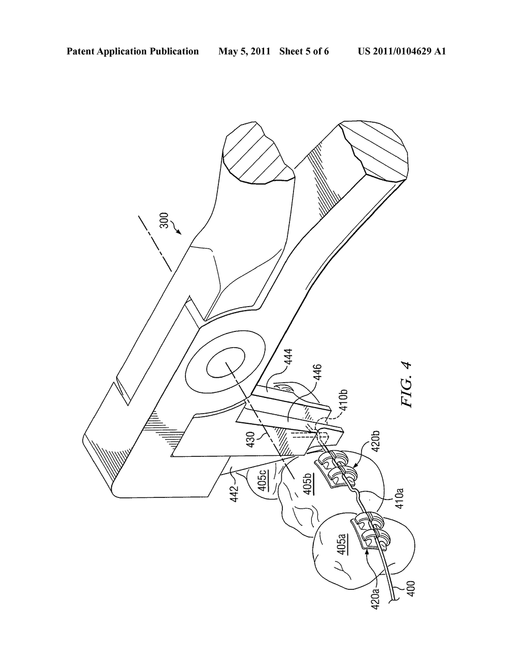 Apparatus and Method for Adjusting Orthodontic Wire - diagram, schematic, and image 06