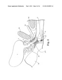 TRANSOBTURATOR METHODS FOR INSTALLING SLING TO TREAT INCONTINENCE, AND RELATED DEVICES diagram and image