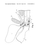 TRANSOBTURATOR METHODS FOR INSTALLING SLING TO TREAT INCONTINENCE, AND RELATED DEVICES diagram and image