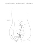 System and Method for Treating Prolapse and Incontinence diagram and image