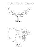 Methods of Predicting Musculoskeletal Disease diagram and image