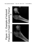 Methods of Predicting Musculoskeletal Disease diagram and image