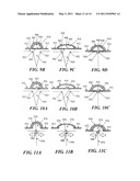 CLOSED INCISION NEGATIVE PRESSURE WOUND THERAPY DEVICE AND METHODS OF USE diagram and image