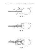 Low-Corrosion Electrode for Treating Tissue diagram and image