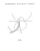 Low-Corrosion Electrode for Treating Tissue diagram and image