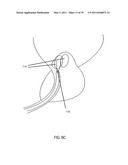 Low-Corrosion Electrode for Treating Tissue diagram and image