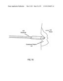 Low-Corrosion Electrode for Treating Tissue diagram and image