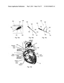 ABLATION CATHETER diagram and image