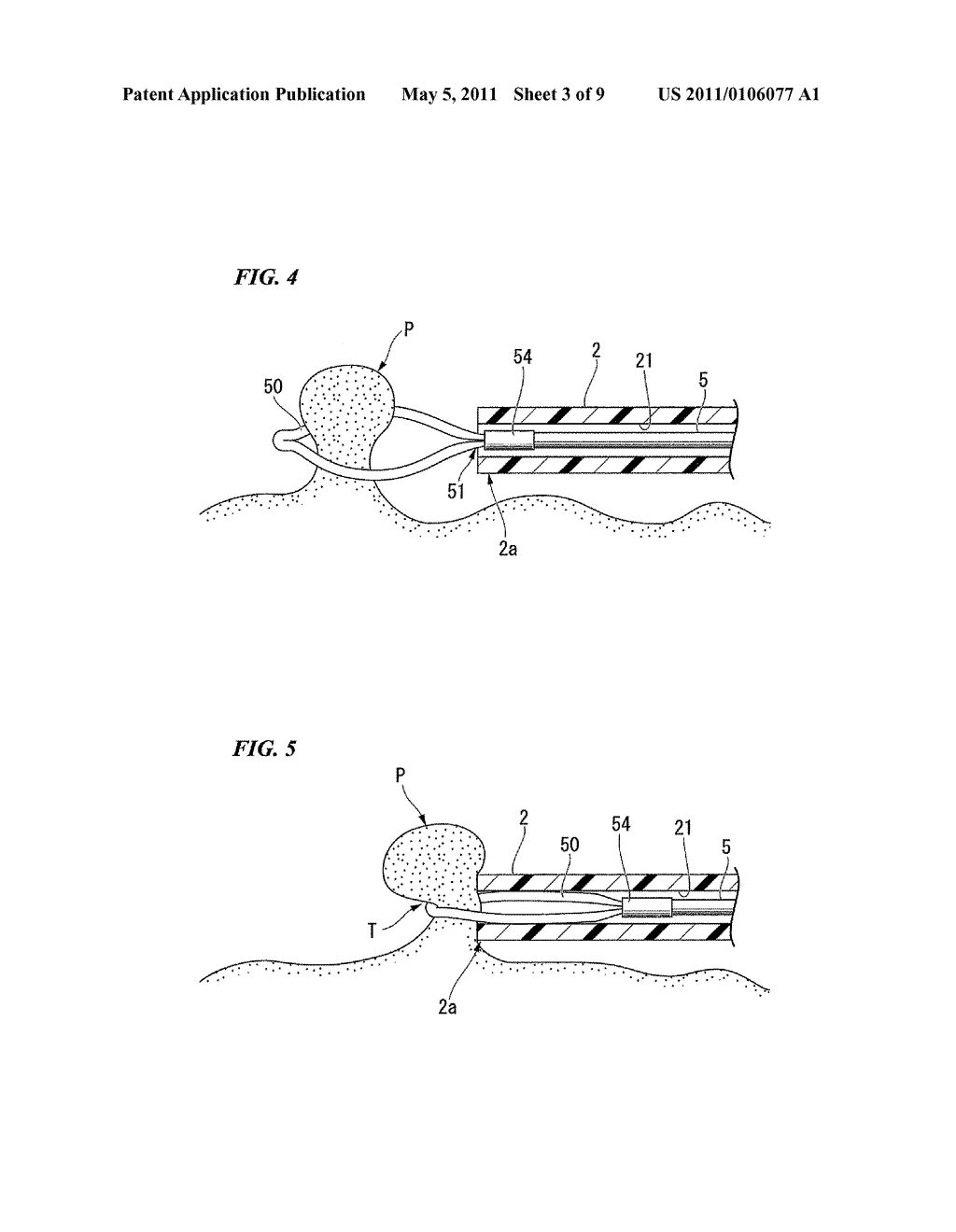 TREATMENT INSTRUMENT - diagram, schematic, and image 04