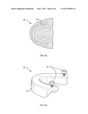 MANDIBULAR DISTRACTION SYSTEM AND METHOD OF USE diagram and image