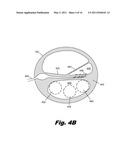 Steerable Stylet diagram and image