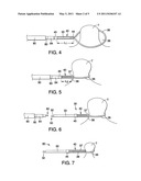 APPARATUS AND METHODS FOR MAINTAINING A FORCE UPON TISSUE USING A LOOP MEMBER diagram and image