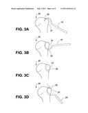 METHOD AND APPARATUS FOR ARTHROSCOPIC ROTATOR CUFF REPAIR USING TRANSOSSEOUS TUNNELS diagram and image