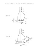 Methods and devices to treat obesity diagram and image