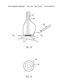 Methods and devices to treat obesity diagram and image