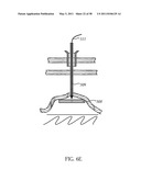 Methods and devices to treat obesity diagram and image