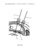 Methods and devices to treat obesity diagram and image