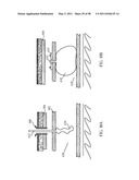 Methods and devices to treat obesity diagram and image