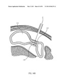 Methods and devices to treat obesity diagram and image