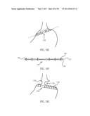 Methods and devices to treat obesity diagram and image