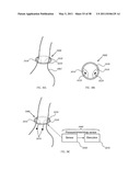 Methods and devices to treat obesity diagram and image