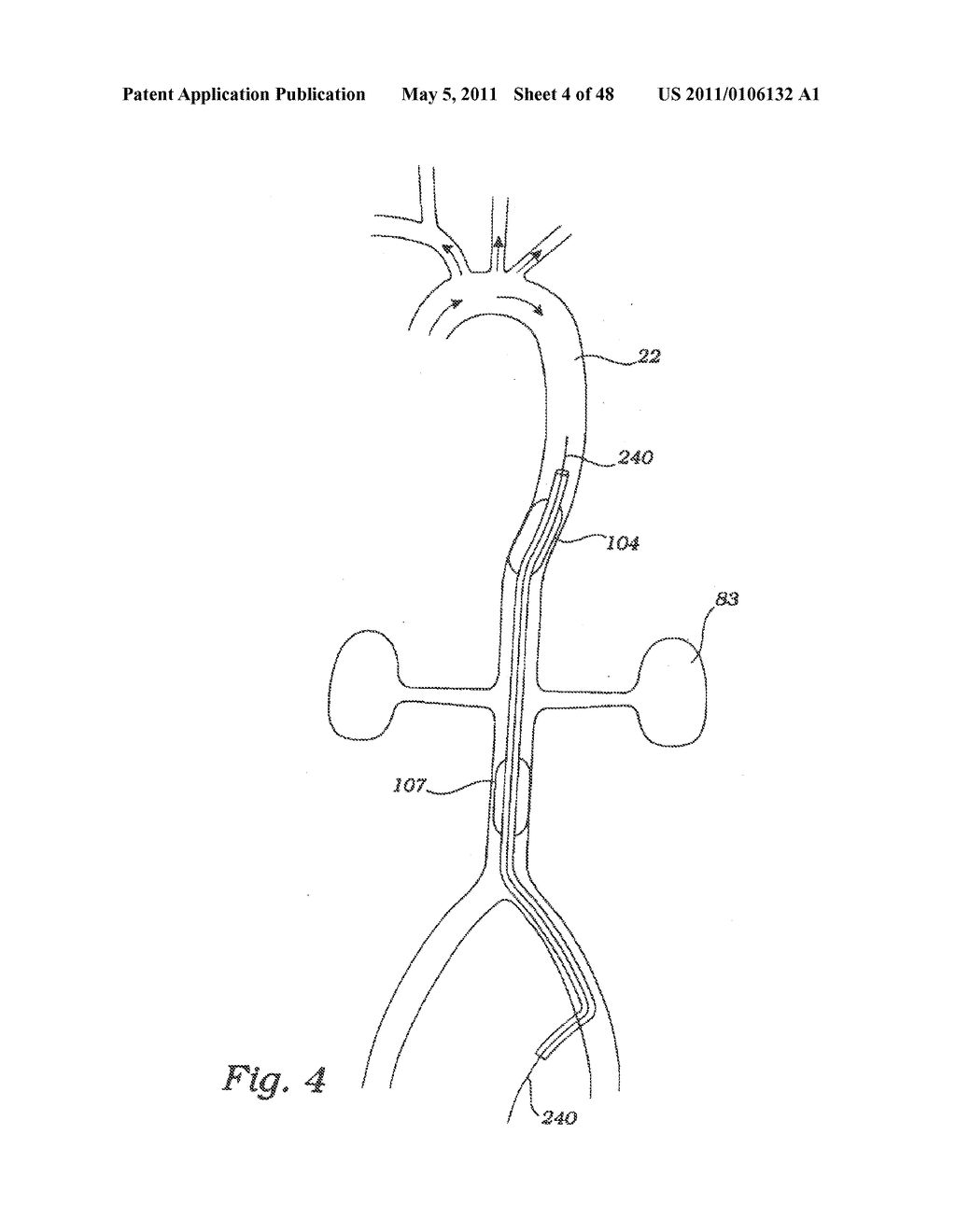 PARTIAL AORTIC OCCLUSION DEVICES AND METHODS FOR CEREBRAL PERFUSION AUGMENTATION - diagram, schematic, and image 05