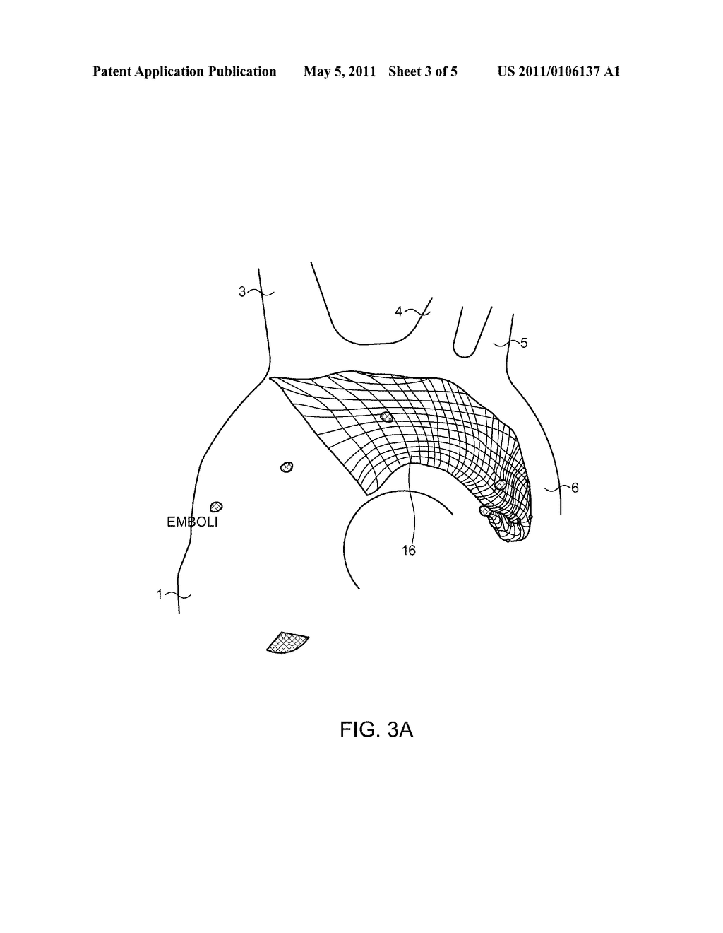 ENDOVASCULAR DEVICE FOR ENTRAPMENT OF PARTICIPATE MATTER AND METHOD FOR USE - diagram, schematic, and image 04