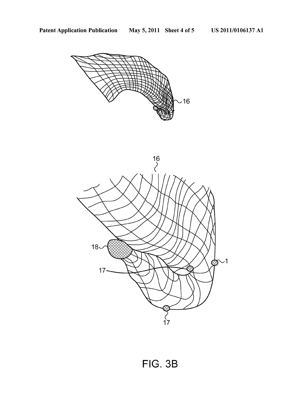 ENDOVASCULAR DEVICE FOR ENTRAPMENT OF PARTICIPATE MATTER AND METHOD FOR USE - diagram, schematic, and image 05