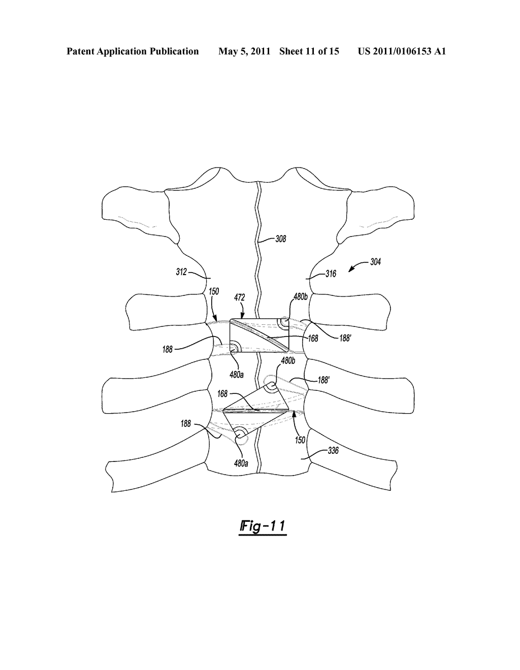 Method and Apparatus for Sternal Closure - diagram, schematic, and image 13