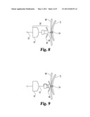 EXTERNAL RETENTION MECHANISM FOR SUTURE ANCHOR diagram and image