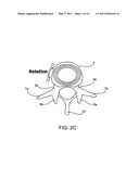 SYSTEMS AND METHODS FOR POSTERIOR DYNAMIC STABILIZATION OF THE SPINE diagram and image