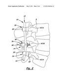 APPARATUS FOR IMPLEMENTING A SPINAL FIXATION SYSTEM WITH SUPPLEMENTAL FIXATION diagram and image