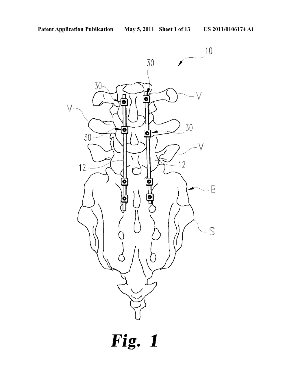 Direct Control Spinal Implant - diagram, schematic, and image 02