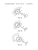 BONE FRAGMENT EXTRACTION diagram and image